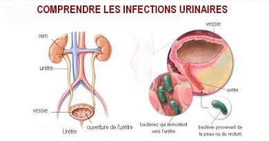 Comprendre les infections urinaires